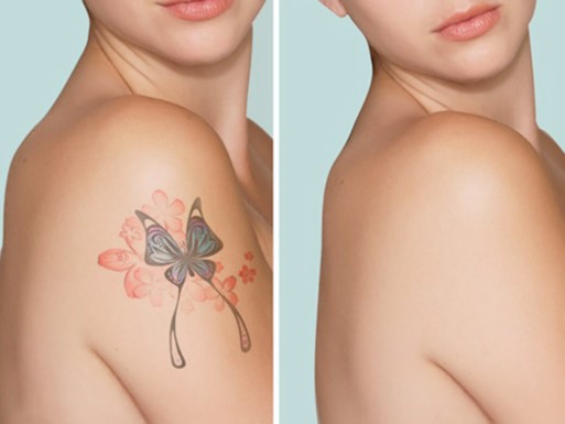 tattoo removal services