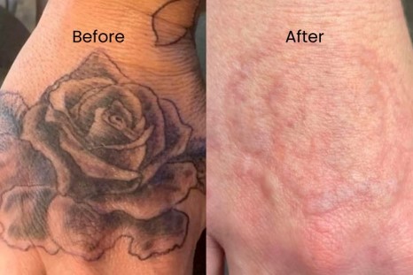 tattoo removal services